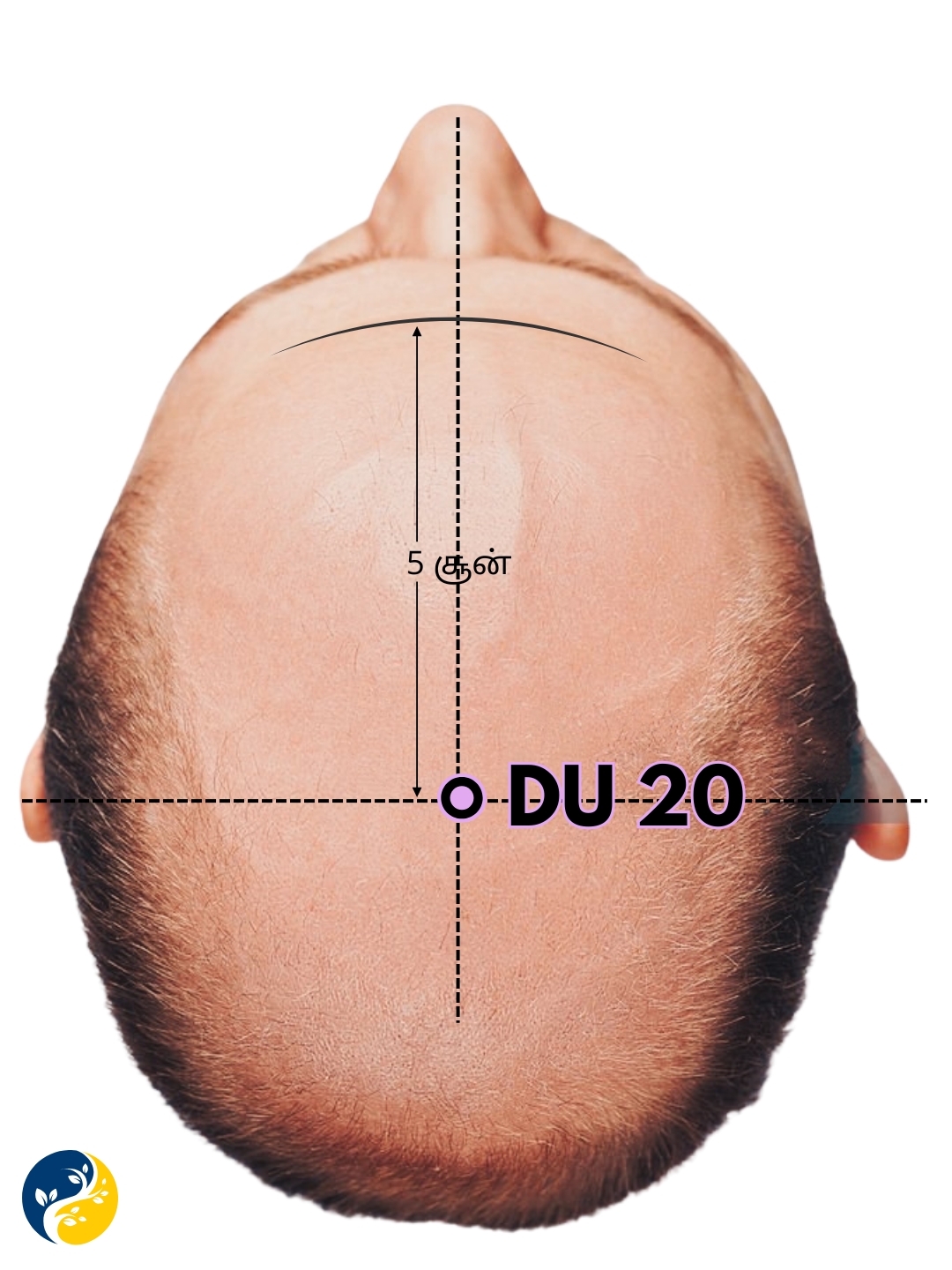 DU20 acupuncture point