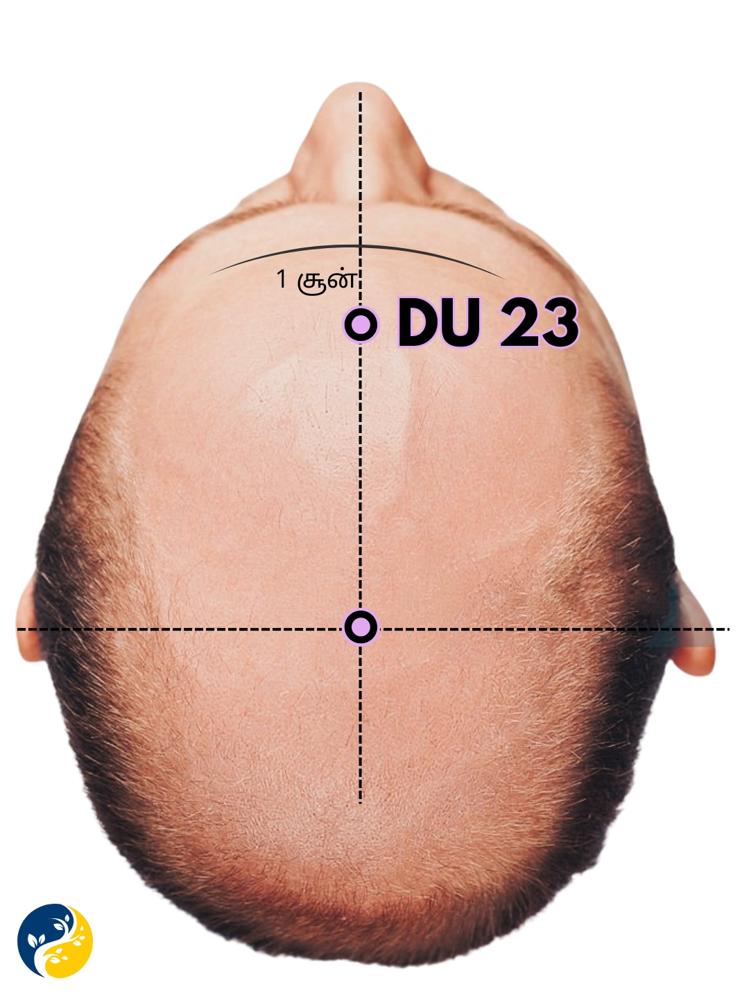DU23 acupuncture point